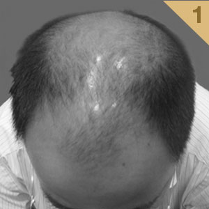 Male Baldness