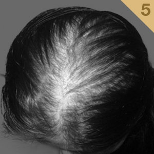 Post-natal Hair Loss